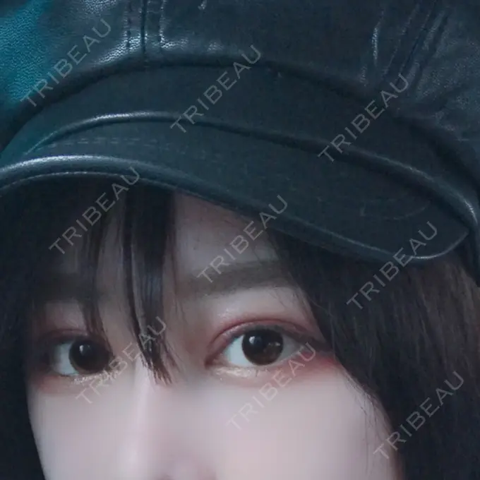 二重切開 / 目頭切開 / 目尻切開 / 上まぶたの脂肪取り / タレ目形成・グラマラスライン（切開） レアート整形外科 AFTER メイン用