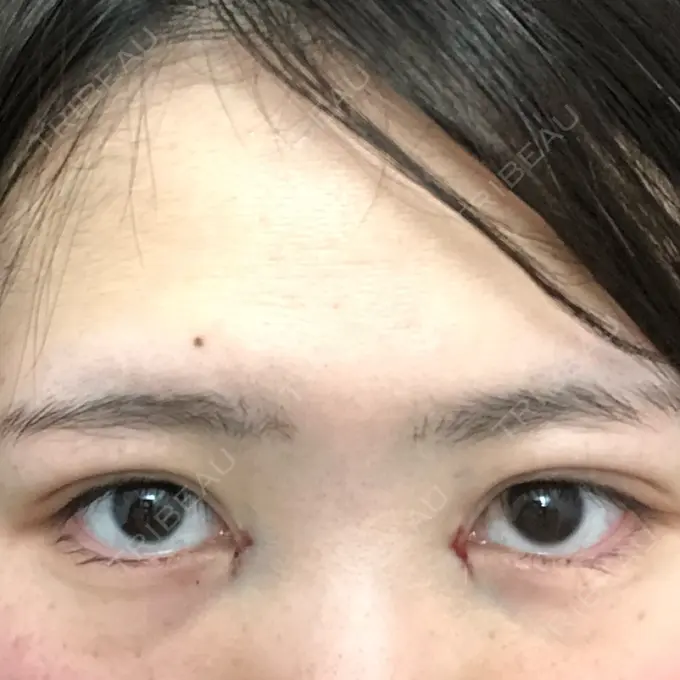 二重埋没 / 二重切開 / 矯正（ワイヤー） 湘南美容クリニック 橋本院 DAY 0 メイン用