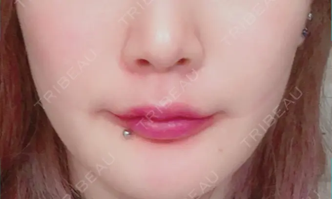 骨切り（あご） アーククリニック DAY 29 メイン用