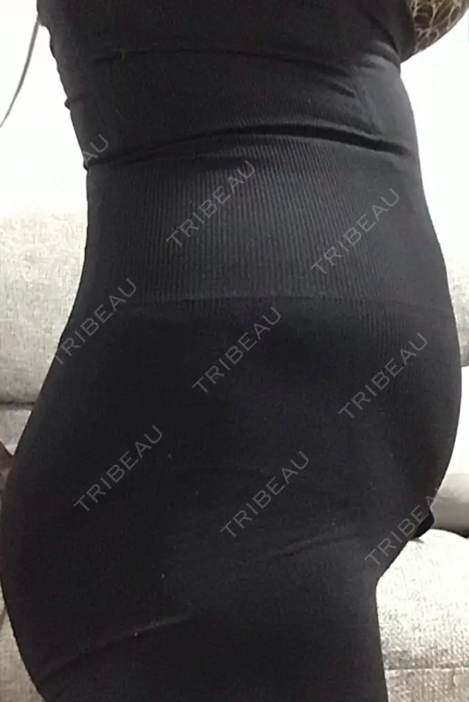 脂肪吸引（お腹） / その他（ボディ） THE CLINIC（ザ・クリニック） 福岡院 DAY 38 メイン用