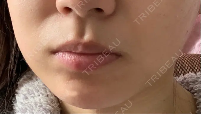 脂肪吸引（顔） 湘南美容クリニック 大阪心斎橋院 DAY 3 メイン用