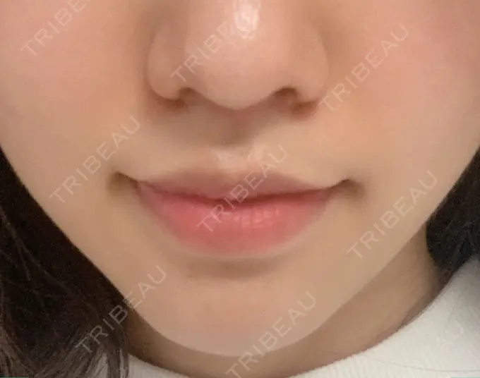 人中短縮 新宿ラクル美容外科クリニック 新宿院 AFTER メイン用