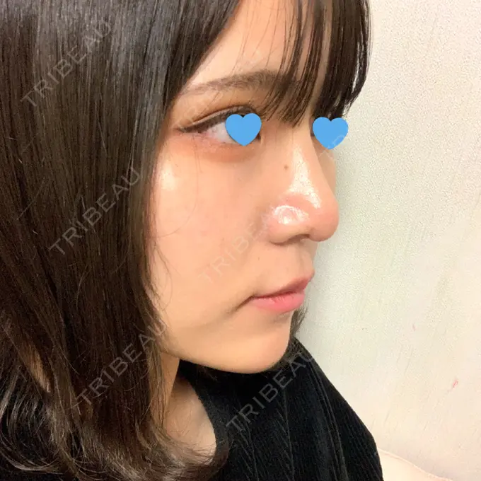 隆鼻術 / 鼻尖形成（切開） / 鼻中隔延長（切開） / 軟骨移植 湘南美容クリニック 名古屋栄院 DAY 28 メイン用