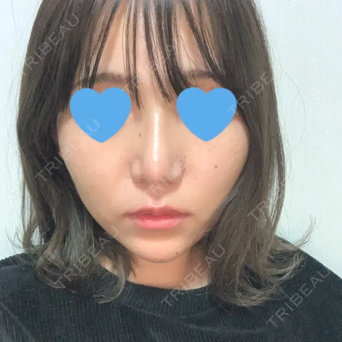 隆鼻術 / 鼻尖形成（切開） / 鼻中隔延長（切開） / 軟骨移植 湘南美容クリニック 名古屋栄院 DAY 28 メイン用