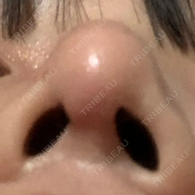 隆鼻術 / 鼻尖形成（切開） / 鼻中隔延長（切開） / 軟骨移植 湘南美容クリニック 名古屋栄院 DAY 28 メイン用