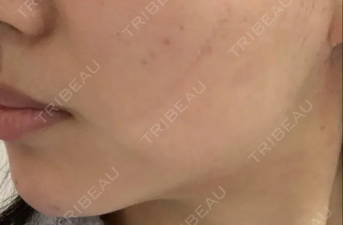 脂肪吸引（顔） 湘南美容クリニック 大阪心斎橋院 AFTER メイン用