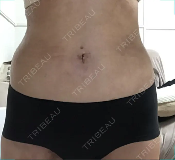 脂肪吸引（お腹） / その他（ボディ） THE CLINIC（ザ・クリニック） 福岡院 DAY 42 メイン用