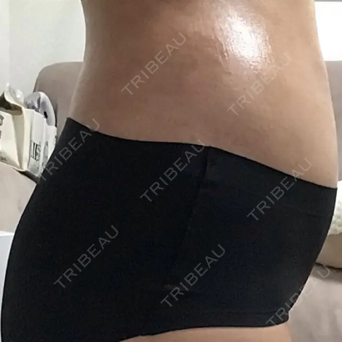 脂肪吸引（お腹） / その他（ボディ） THE CLINIC（ザ・クリニック） 福岡院 DAY 42 メイン用