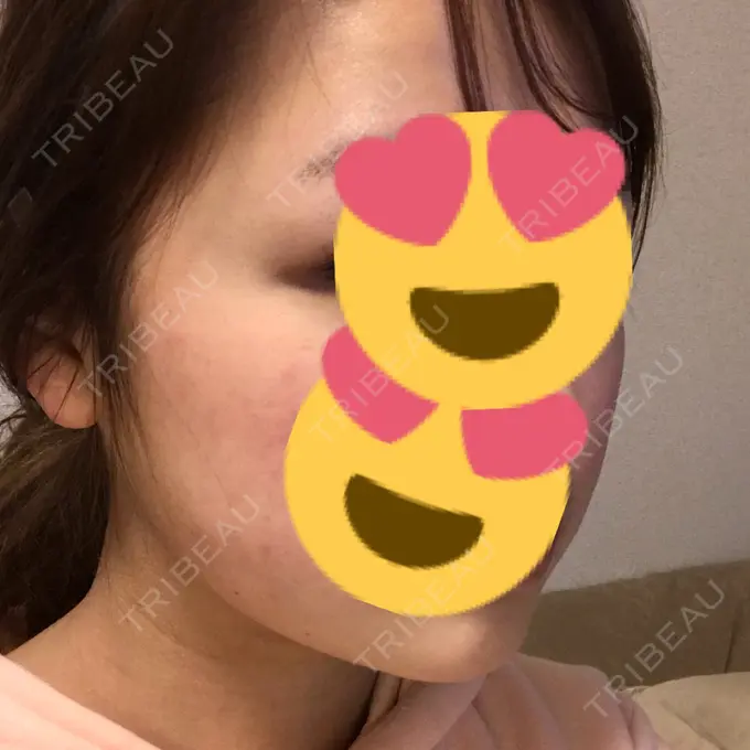 脂肪吸引（顔） 湘南美容クリニック 銀座院 DAY 40 メイン用