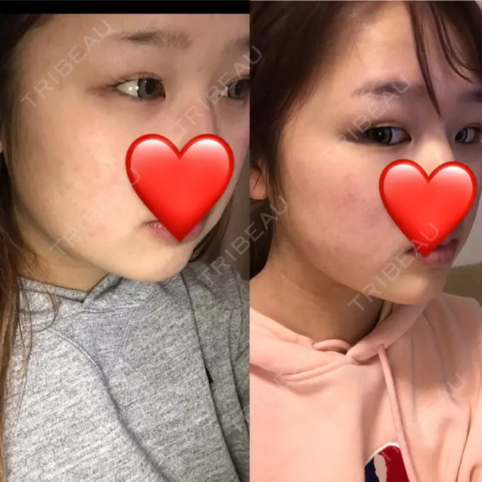 脂肪吸引（顔） 湘南美容クリニック 銀座院 DAY 40 メイン用