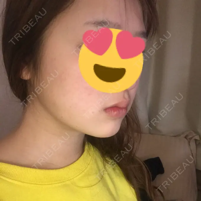 脂肪吸引（顔） 湘南美容クリニック 銀座院 AFTER メイン用