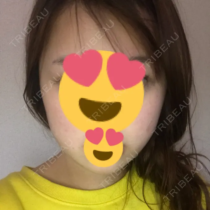 脂肪吸引（顔） 湘南美容クリニック 銀座院 DAY 44 メイン用