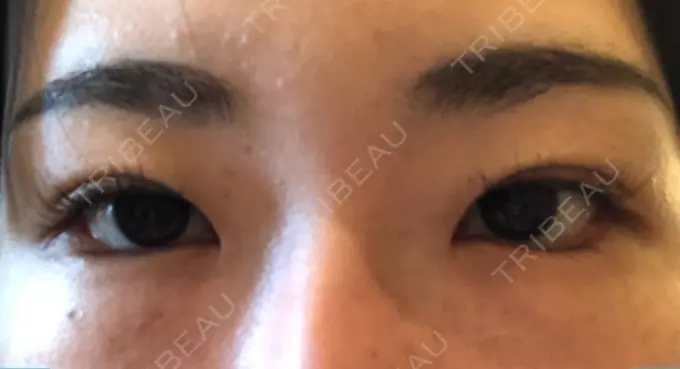 目尻切開 / タレ目形成・グラマラスライン（切開） A CLINIC（エークリニック） 横浜院 DAY 7 メイン用