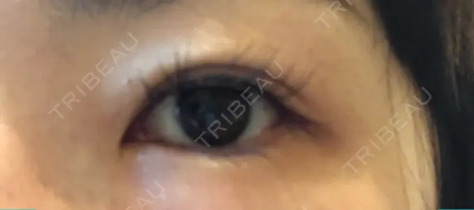 目尻切開 / タレ目形成・グラマラスライン（切開） A CLINIC（エークリニック） 横浜院 DAY 7 メイン用