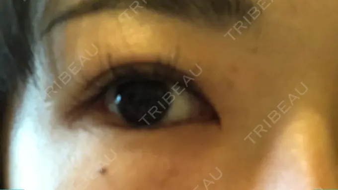 目尻切開 / タレ目形成・グラマラスライン（切開） A CLINIC（エークリニック） 横浜院 DAY 7 メイン用