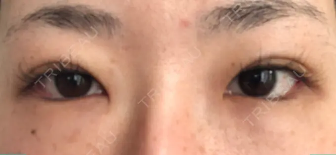 目尻切開 / タレ目形成・グラマラスライン（切開） A CLINIC（エークリニック） 横浜院 AFTER メイン用