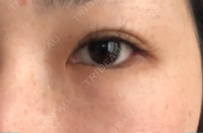 目尻切開 / タレ目形成・グラマラスライン（切開） A CLINIC（エークリニック） 横浜院 DAY 14 メイン用