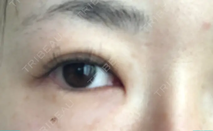 目尻切開 / タレ目形成・グラマラスライン（切開） A CLINIC（エークリニック） 横浜院 DAY 14 メイン用