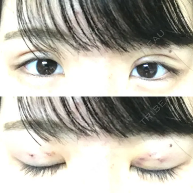 二重埋没 / ヒアルロン酸注入（涙袋） ルラ美容クリニック 新宿院 DAY 93 メイン用