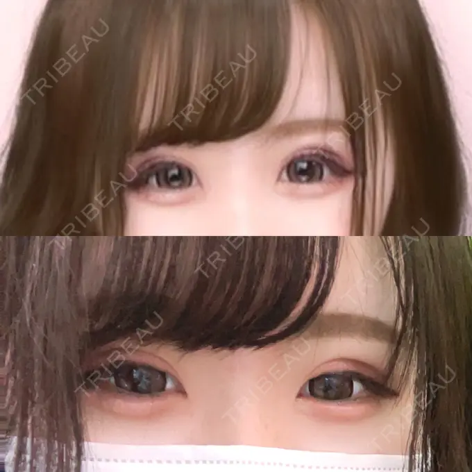 二重埋没 / ヒアルロン酸注入（涙袋） ルラ美容クリニック 新宿院 DAY 107 メイン用