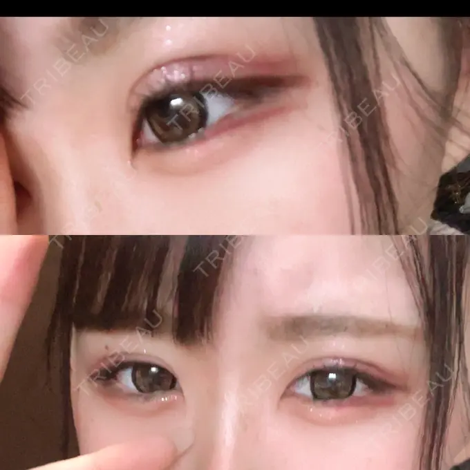 二重埋没 / ヒアルロン酸注入（涙袋） ルラ美容クリニック 新宿院 DAY 115 メイン用