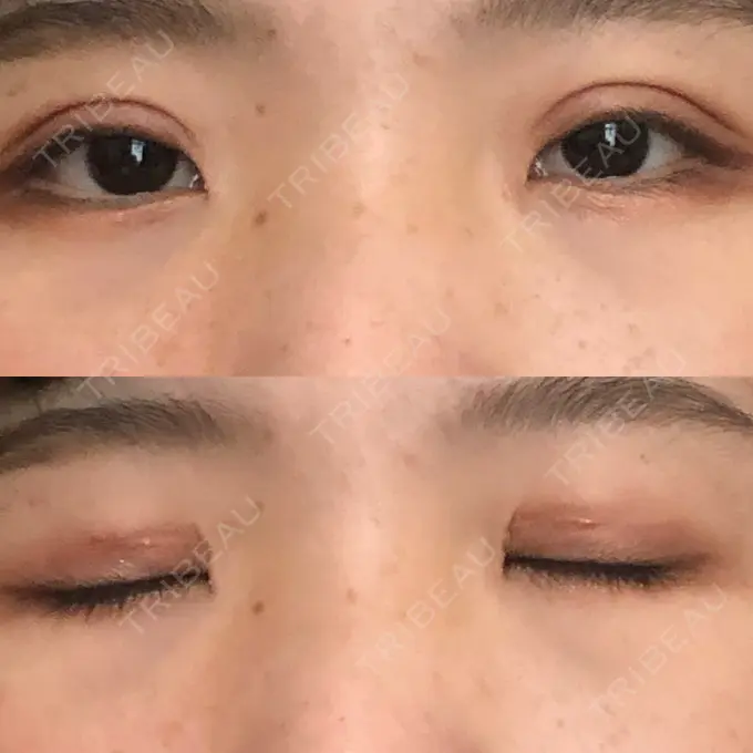 二重切開 城本クリニック 福岡院 DAY 61 メイン用