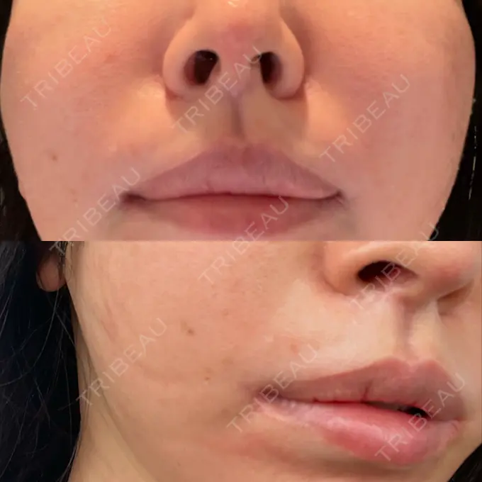 人中短縮 / 口角挙上 / その他（口元） グリム整形外科 DAY 752 メイン用