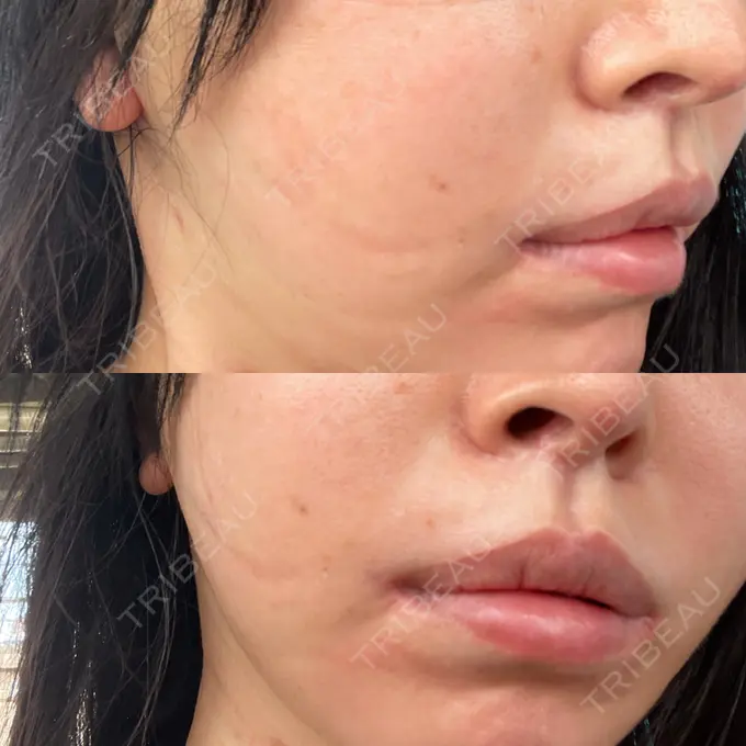 人中短縮 / 口角挙上 / その他（口元） グリム整形外科 DAY 752 メイン用