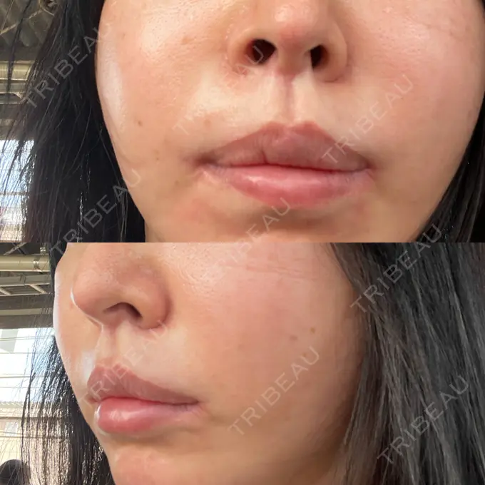 人中短縮 / 口角挙上 / その他（口元） グリム整形外科 DAY 752 メイン用