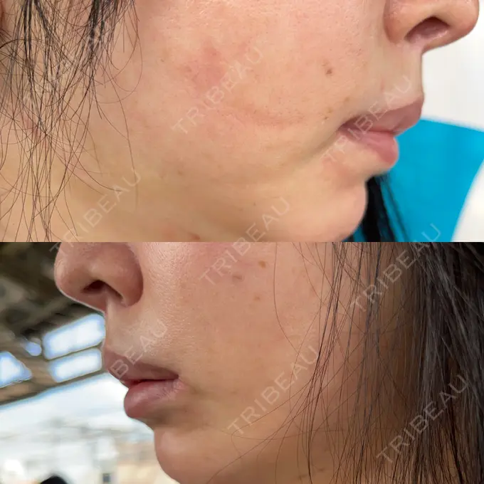 人中短縮 / 口角挙上 / その他（口元） グリム整形外科 DAY 752 メイン用