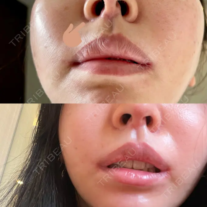 人中短縮 / 口角挙上 / その他（口元） グリム整形外科 DAY 752 メイン用