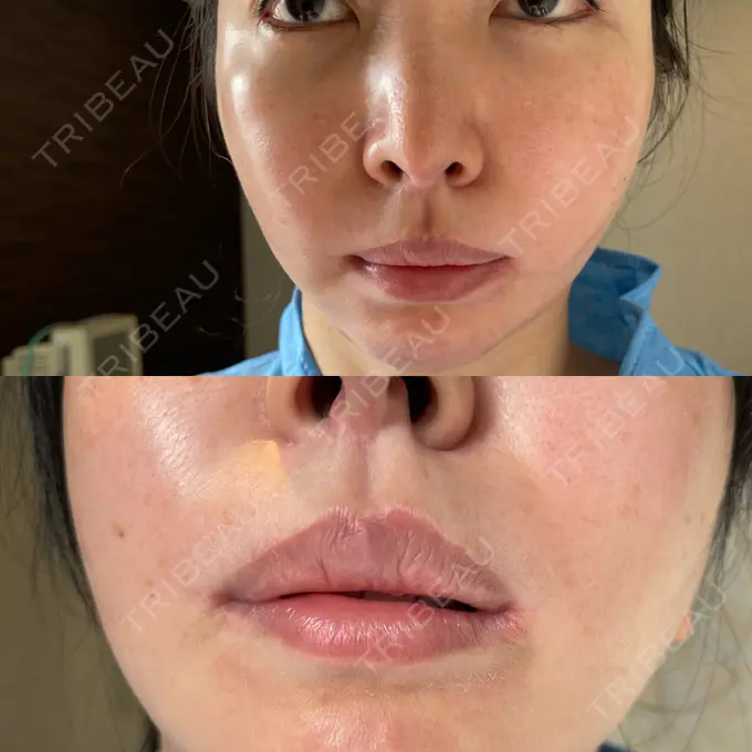 人中短縮 / 口角挙上 / その他（口元） グリム整形外科 DAY 752 メイン用