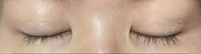 二重切開 / 上まぶたの脂肪取り 城本クリニック 豊橋院 DAY 147 メイン用