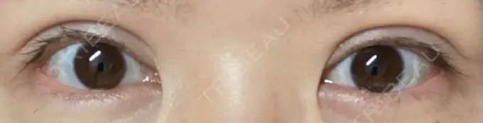 二重切開 / 上まぶたの脂肪取り 城本クリニック 豊橋院 DAY 147 メイン用