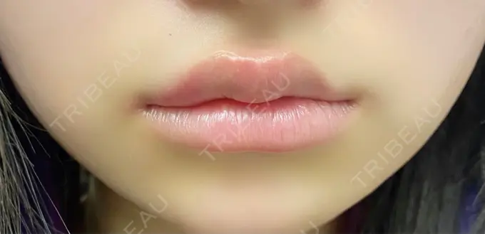 ヒアルロン酸注入（唇） / ボトックス（口角） ルラ美容クリニック 渋谷本院 AFTER メイン用