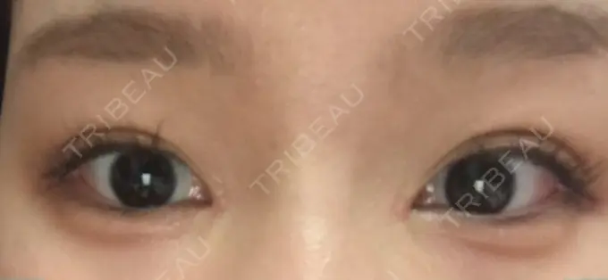 ヒアルロン酸注入（涙袋） フィラークリニック 横浜院 DAY 12 メイン用