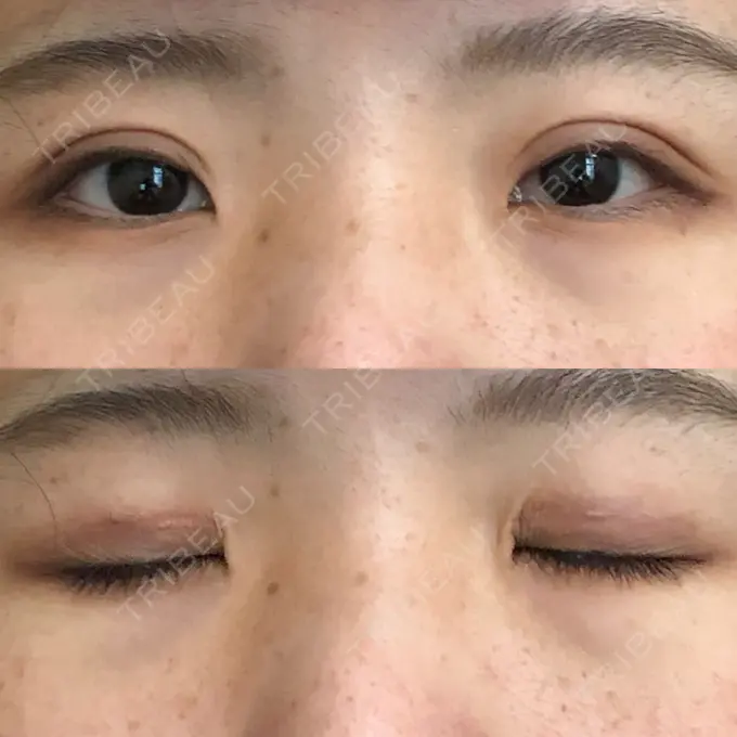 二重切開 城本クリニック 福岡院 DAY 63 メイン用