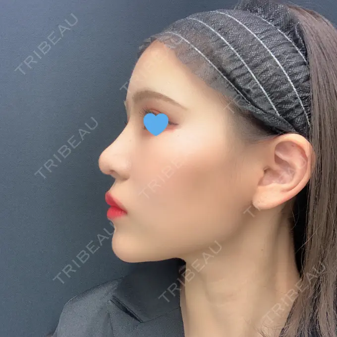 隆鼻術 / 鼻尖形成（切開） / 鼻中隔延長（切開） / 軟骨移植 湘南美容クリニック 名古屋栄院 DAY 31 メイン用