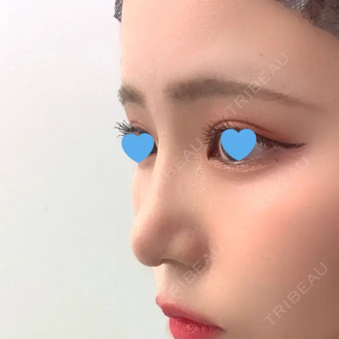 隆鼻術 / 鼻尖形成（切開） / 鼻中隔延長（切開） / 軟骨移植 湘南美容クリニック 名古屋栄院 DAY 31 メイン用