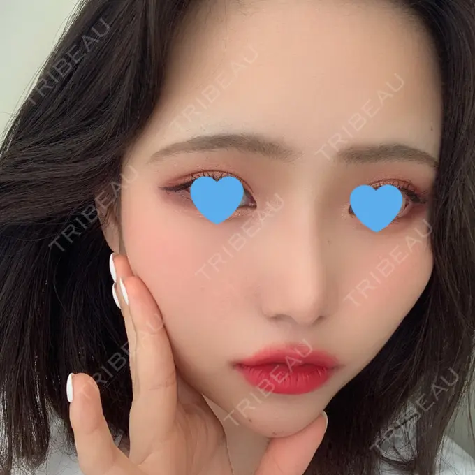 隆鼻術 / 鼻尖形成（切開） / 鼻中隔延長（切開） / 軟骨移植 湘南美容クリニック 名古屋栄院 DAY 31 メイン用