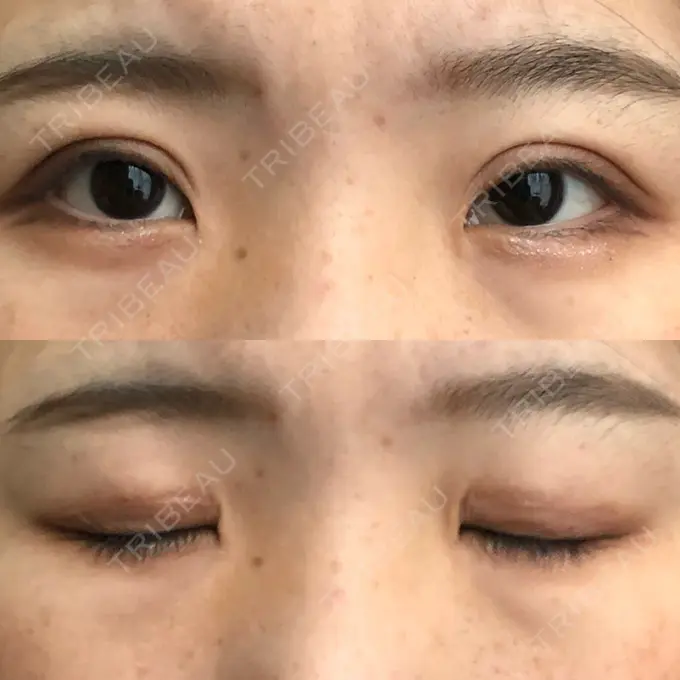 二重切開 城本クリニック 福岡院 DAY 59 メイン用