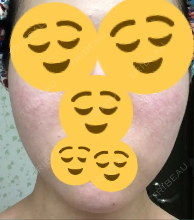 その他（肌） / 再生医療 / PRP皮膚再生療法 聖心美容クリニック 六本木院 AFTER メイン用