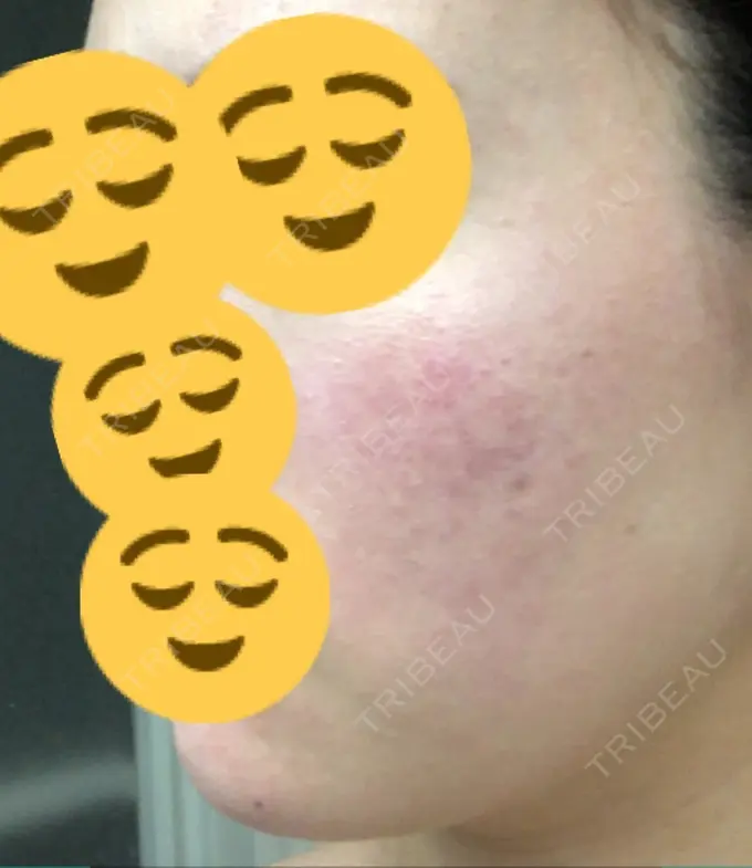 その他（肌） / 再生医療 / PRP皮膚再生療法 聖心美容クリニック 六本木院 DAY 376 メイン用