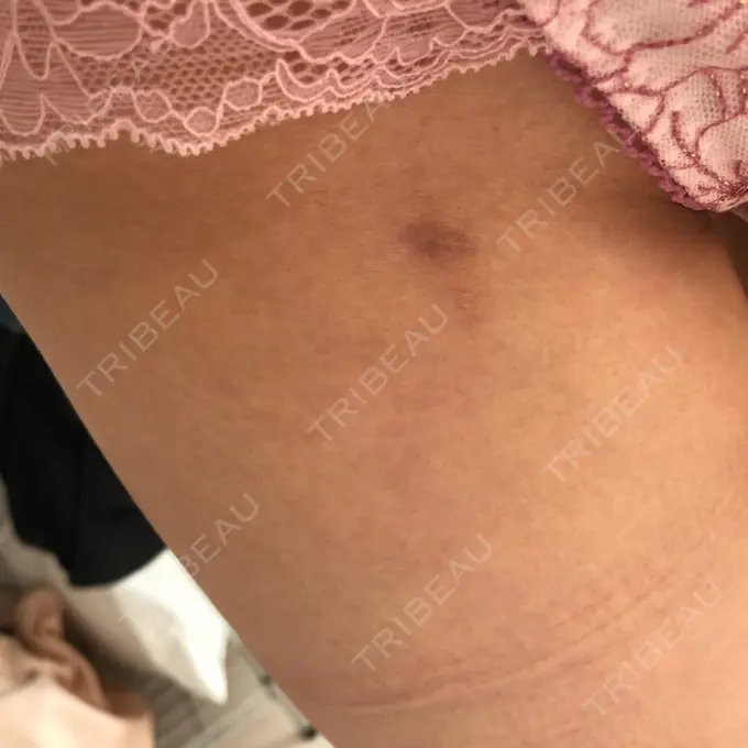 脂肪吸引（脚） / 豊胸（脂肪注入） 神戸中央クリニック美容外科 DAY 154 メイン用