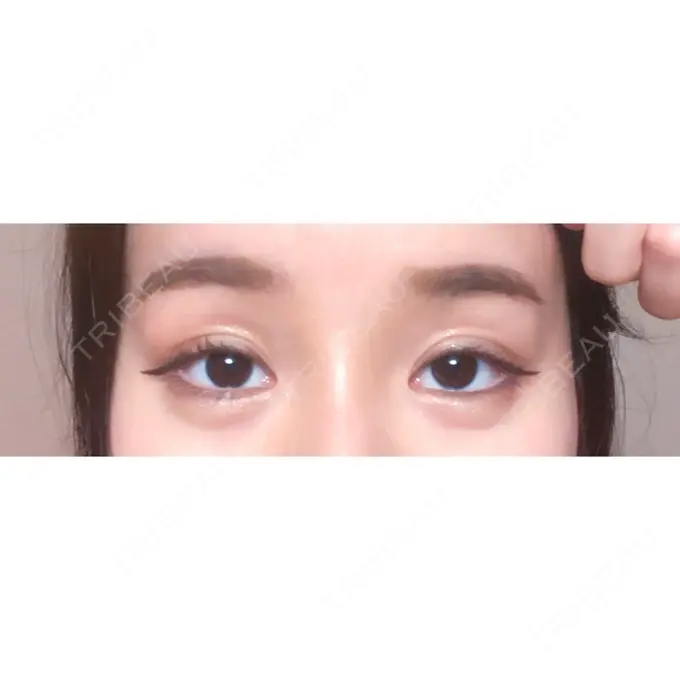 二重切開 / 目頭切開 / 眼瞼下垂（切開） / 目尻切開 / タレ目形成・グラマラスライン（切開） / 前額リフト F5整形外科 AFTER メイン用