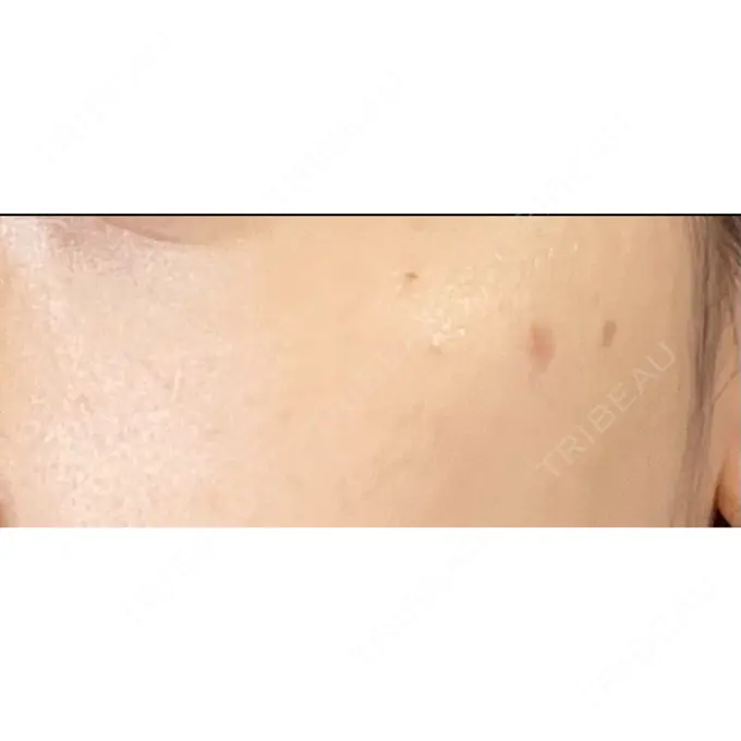 シミ取りレーザー / ピコレーザートーニング（美白・肝斑） PICO BEAUTY CLINIC DAY 1 メイン用