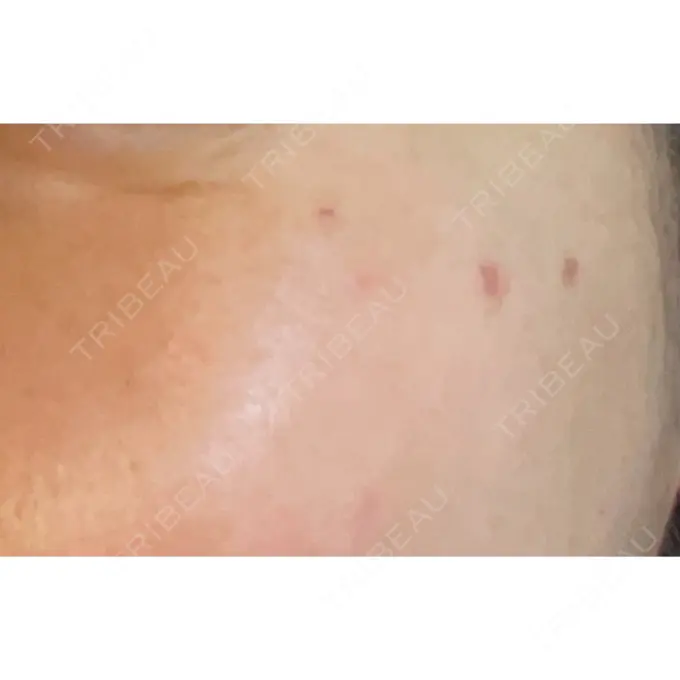 シミ取りレーザー / ピコレーザートーニング（美白・肝斑） PICO BEAUTY CLINIC DAY 2 メイン用