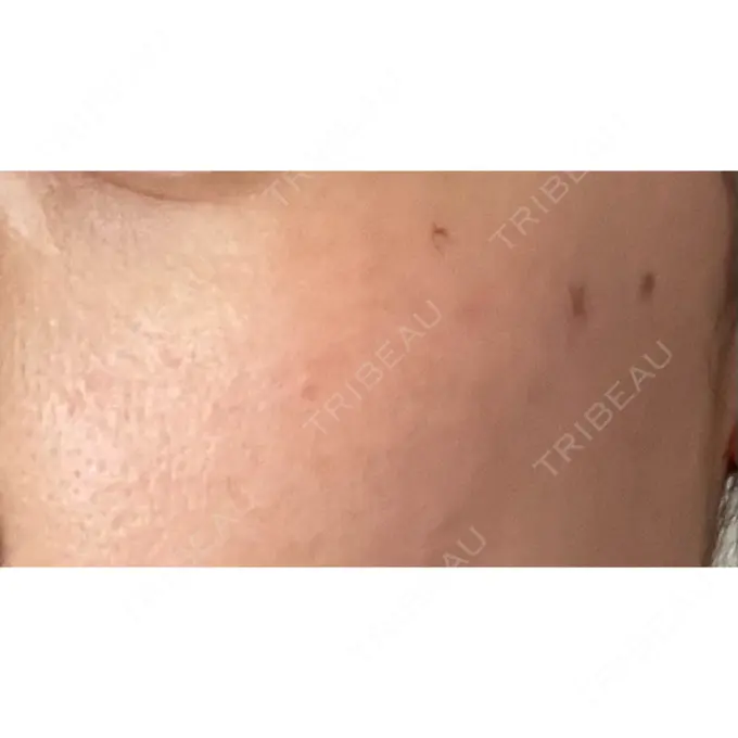 シミ取りレーザー / ピコレーザートーニング（美白・肝斑） PICO BEAUTY CLINIC DAY 3 メイン用