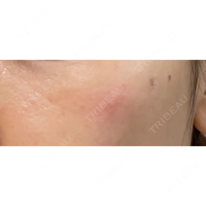 シミ取りレーザー / ピコレーザートーニング（美白・肝斑） PICO BEAUTY CLINIC DAY 5 メイン用