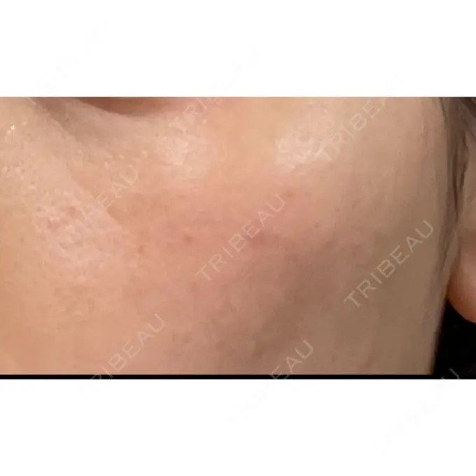 シミ取りレーザー / ピコレーザートーニング（美白・肝斑） PICO BEAUTY CLINIC DAY 6 メイン用